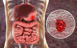 Charger l'image dans la galerie, FINIR LES ULCÈRES AVEC™ULCER-FREE BIO
